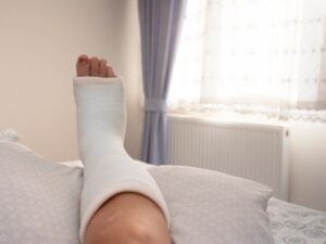 An injured man in a hospital bed with a cast on his leg. Our personal injury attorneys in Beverly Hills can help you pursue the maximum compensatory damages available after an accident.